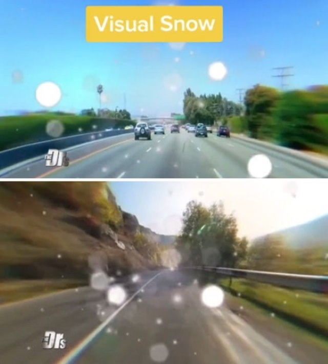 How People With Vision Limitations See the World Visual snow
