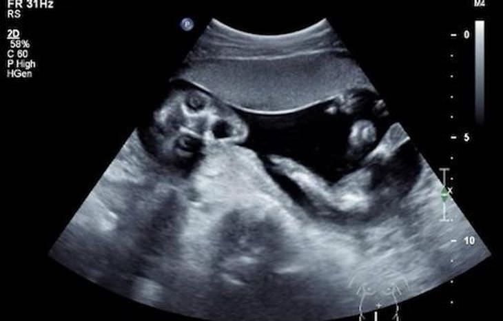 Funny Photos Capturing the Essence of Parenthood funny ultrasound