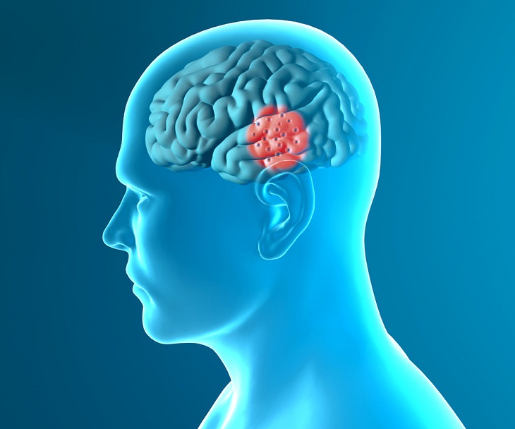 Neurodegenerative Diseases, brain disease