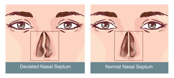 Snoring Causes deviated nasal septum