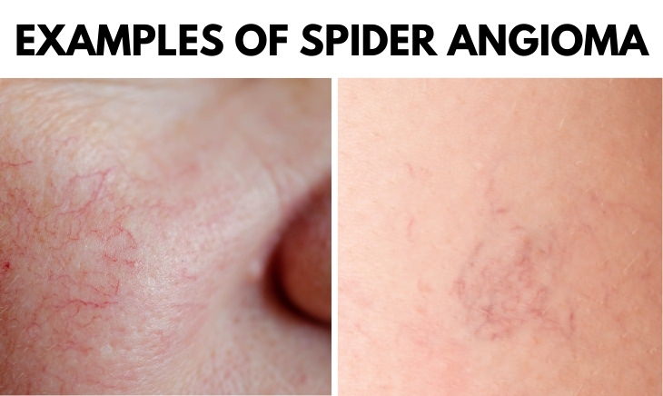 Spider Angioma examples