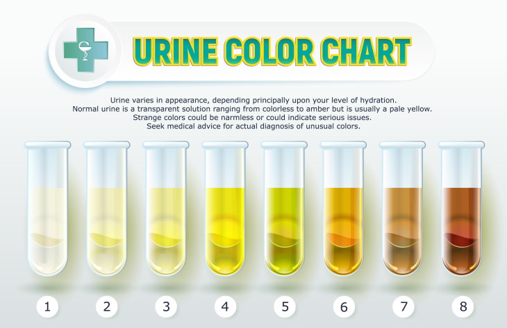 Brown Urine Causes urine color chart