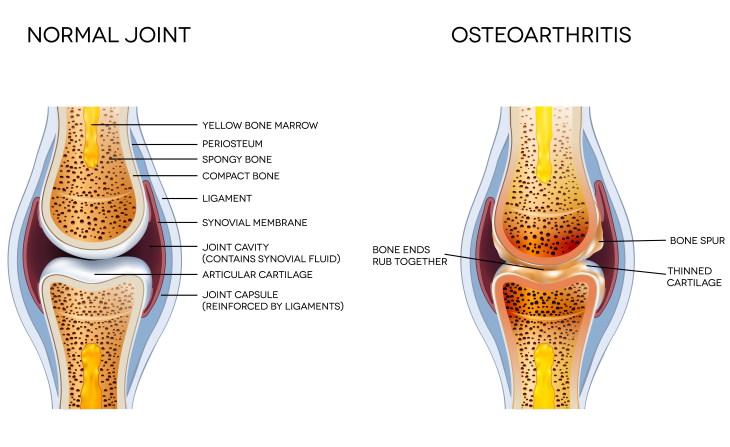 Arthritis Types Osteoarthritis