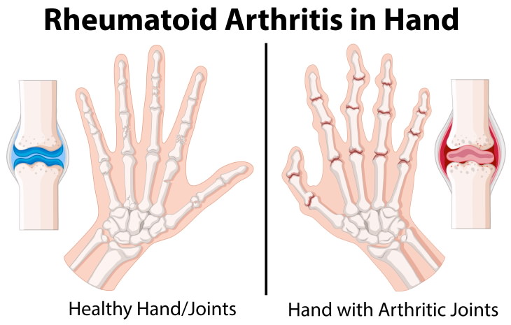 Arthritis Types  Rheumatoid arthritis