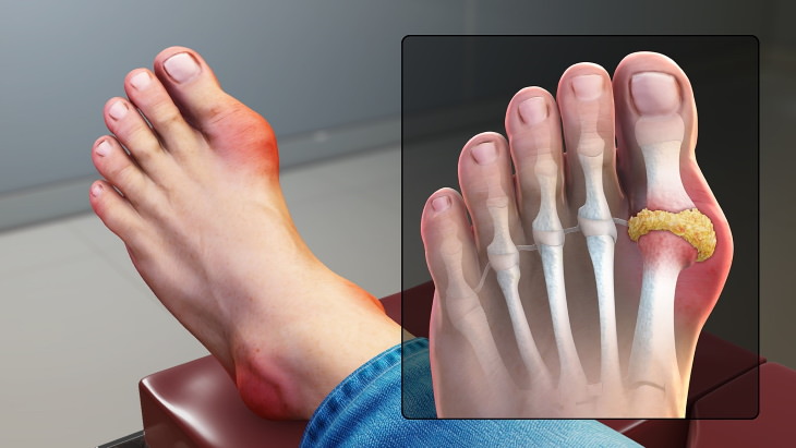 Arthritis Types Gout
