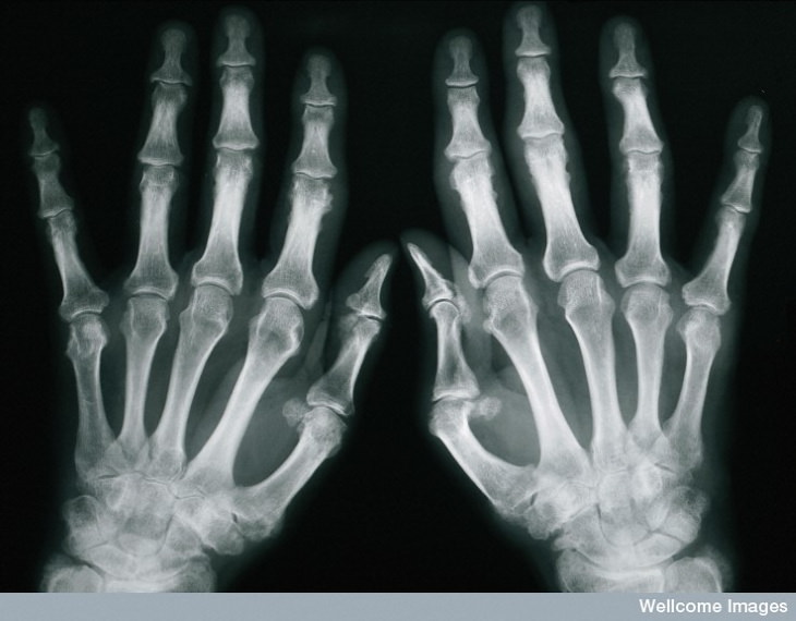 Arthritis Types Psoriatic arthritis