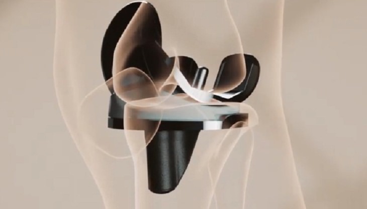 Medical Breakthroughs of 2021,  Knee Replacement with "Smart" Implant