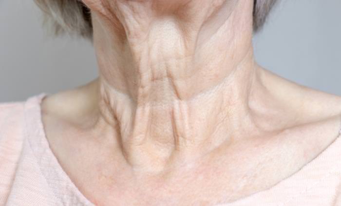 wrinkles on the neck