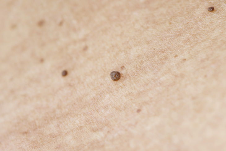 Skin Tag Removal skin tags