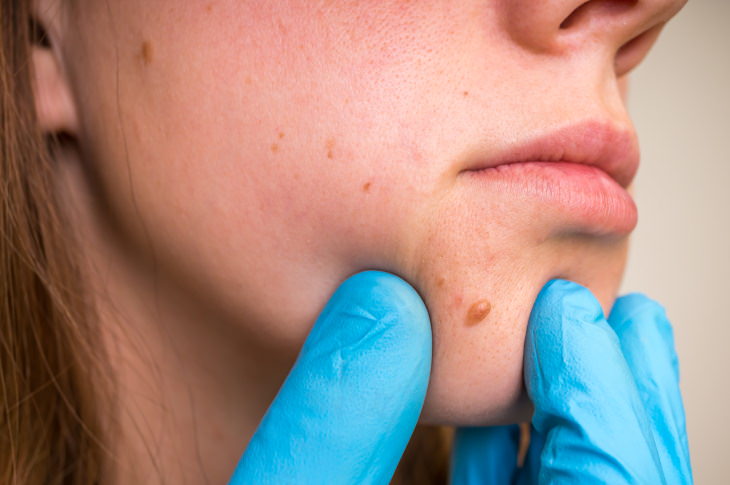 Skin Tag Removal mole examination