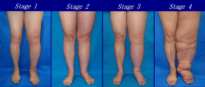 lymphederma stages 