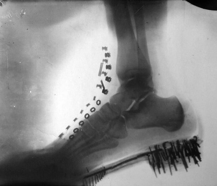 Vintage Photos Nikola Tesla's foot under an X-Ray (1896)