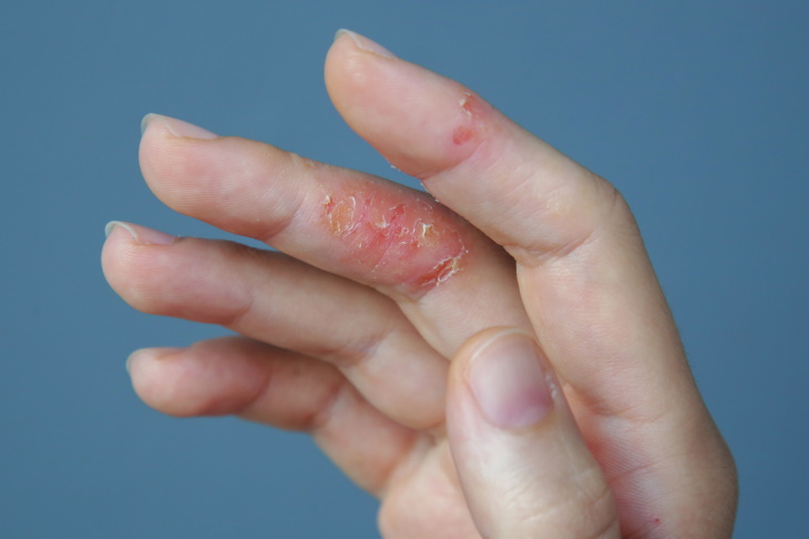 Types of Eczema Dyshidrotic eczema