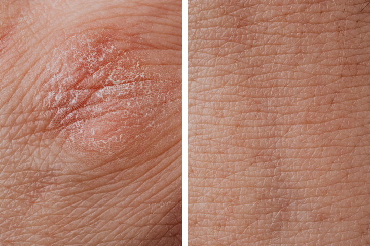 Types of Eczema Dry skin and eczema