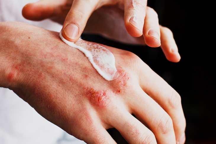 Types of Eczema applying cream on rash