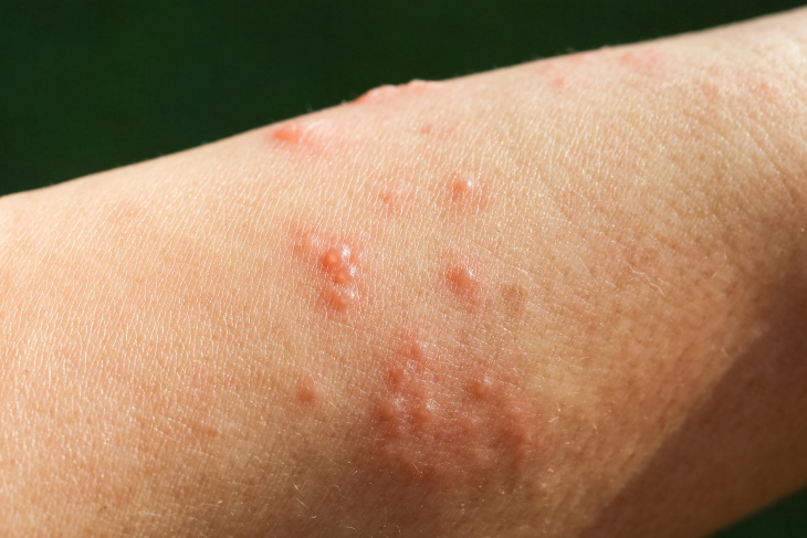 Types of Eczema Contact dermatitis 