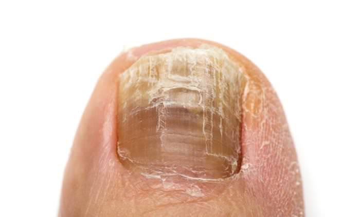 yellow toenails causes and treatments