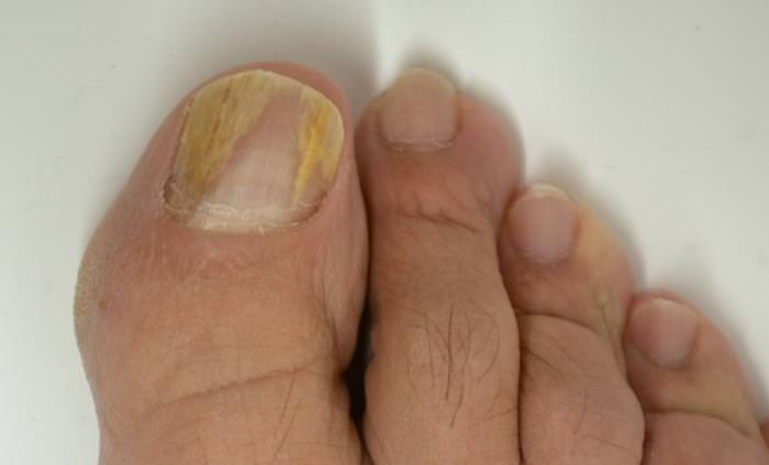 Causas De Las Uñas Amarillas, uña amarilla en dedo gordo del pie