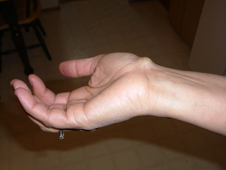 Wrist Pain Causes Ganglion cyst