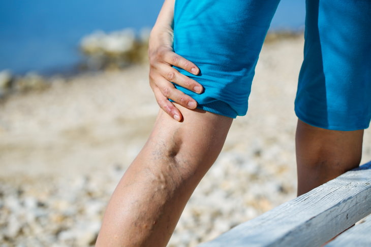 Bad Posture varicose veins