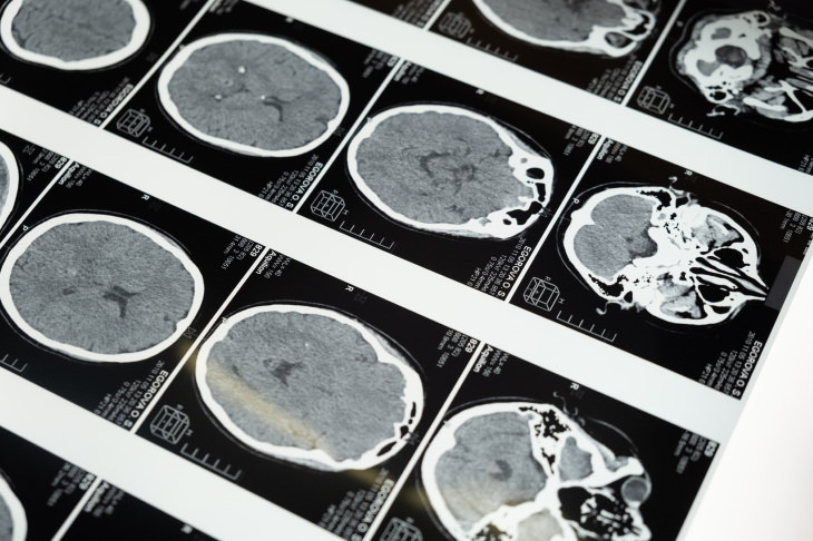Stroke Myths brain imaging