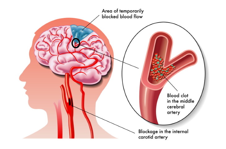 Stroke Myths ministroke