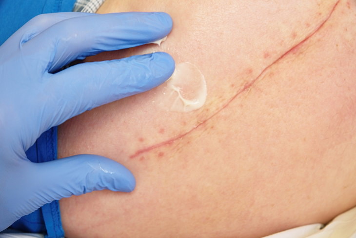 Scarring Prevention surgery scar cream