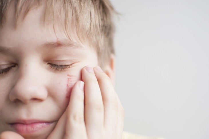 Scarring Prevention boy with a scratch on face