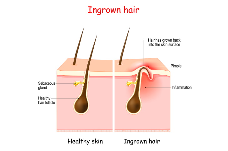 Hair Removal Myths Ingrown hair