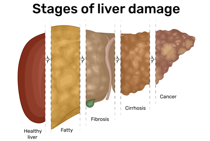 Fatty Liver Disease and B Vitamins stages of liver damage