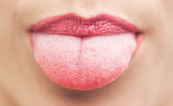 Symptoms of Anemia tongue