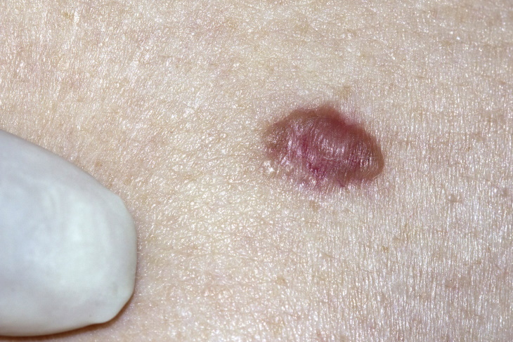 Types of Skin Cancer Basal cell carcinoma (BCC)