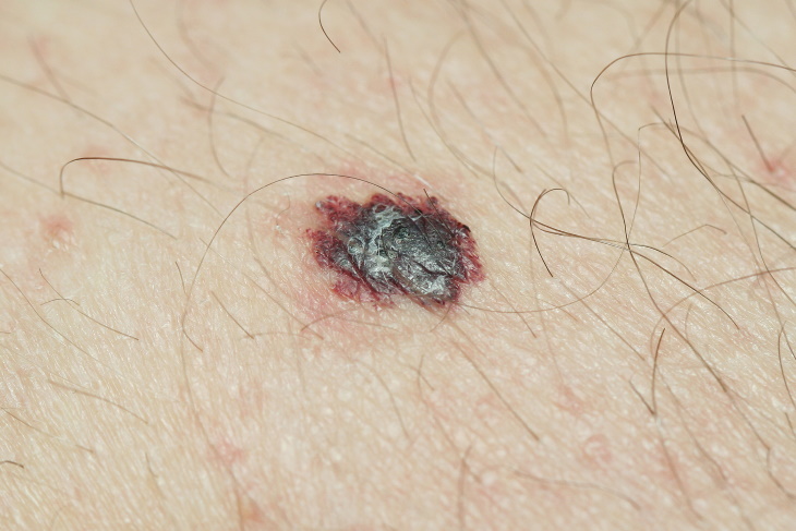 Types of Skin Cancer Melanoma