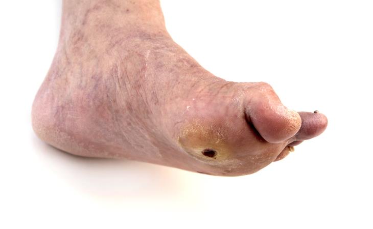 diabetic foot ulcer