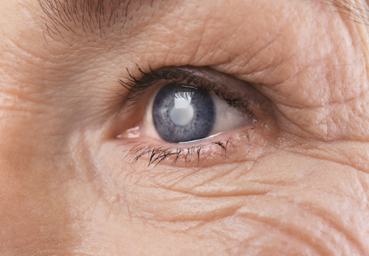 Foods for Cataract Prevention woman with cataract
