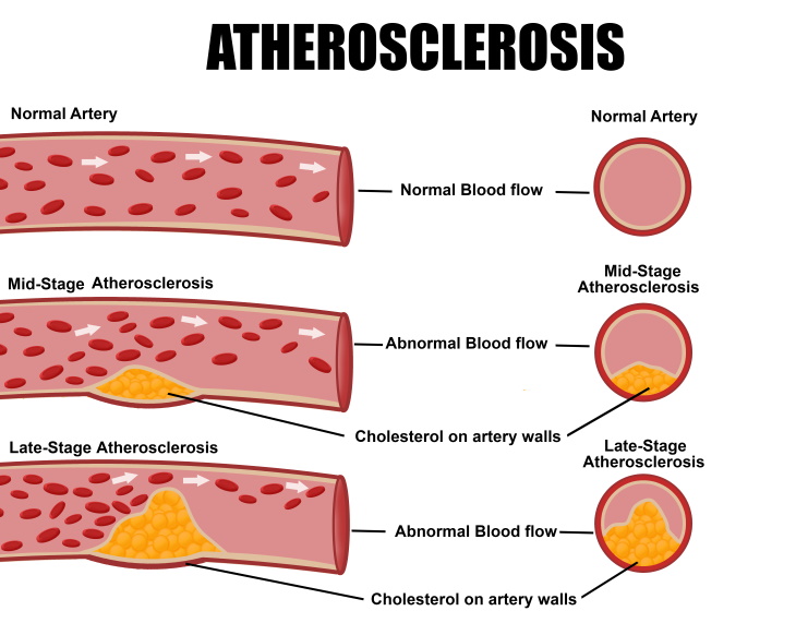 Cholesterol Tests Atherosclerosis