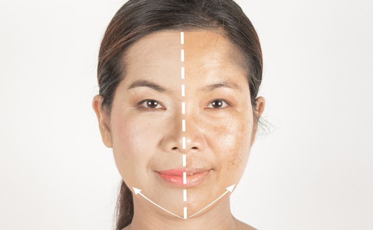 woman's face divided into pigmented and non pigmented skin