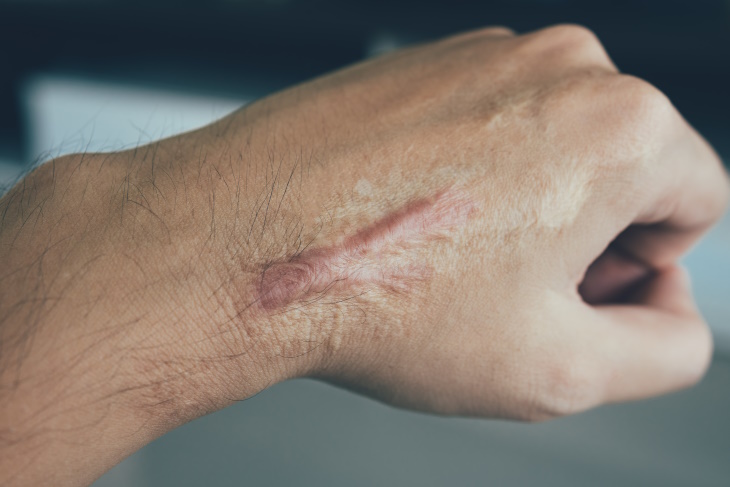  MedicalTerms For Bodily Functions scar on hand