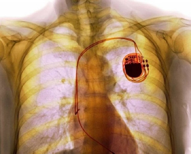 Fascinating X-Rays, pacemaker 