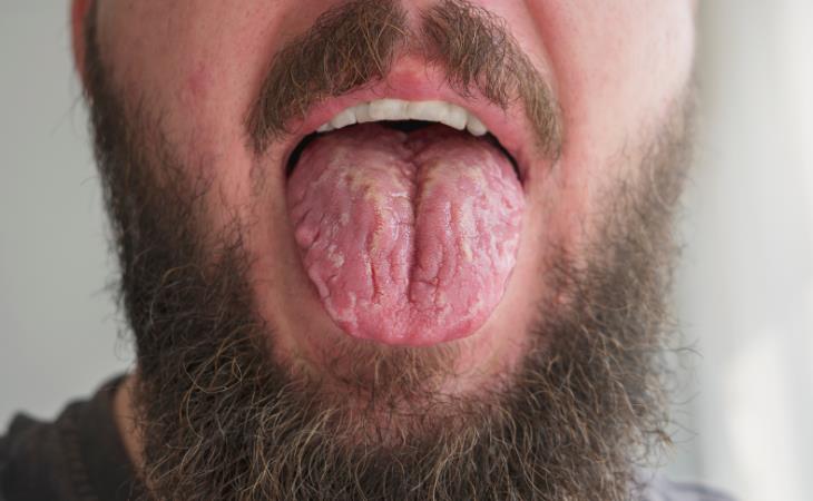 Geographic tongue