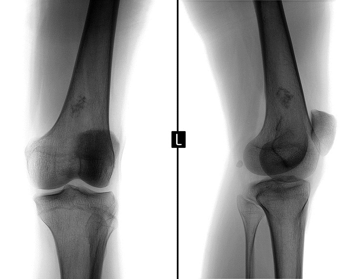 Ewing sarcoma