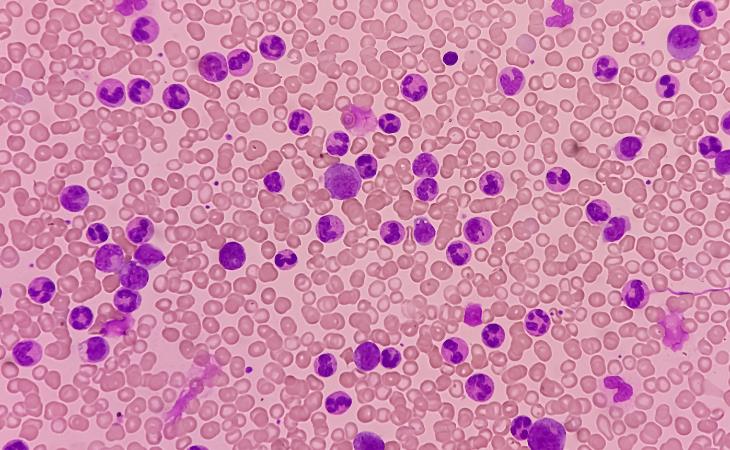 Chronic myeloid leukemia