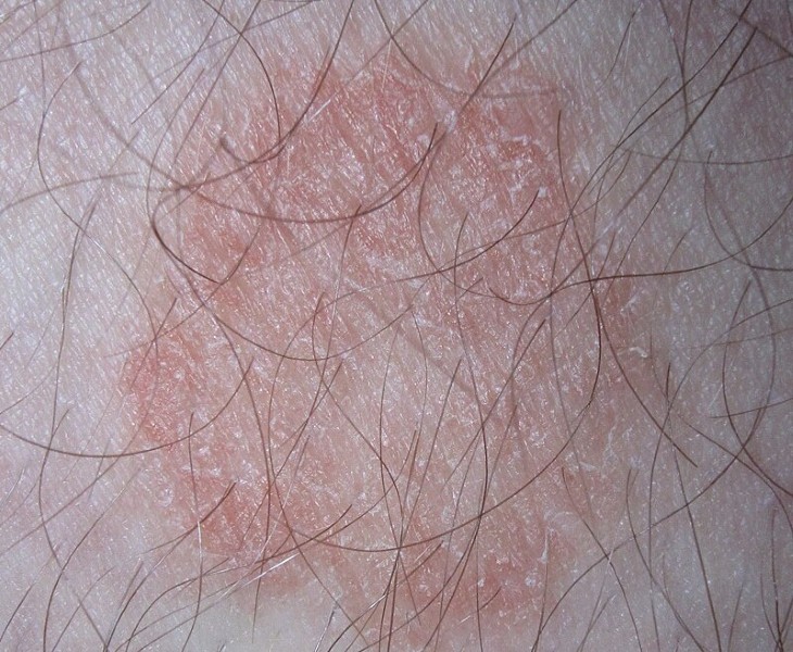 scalp skin conditions