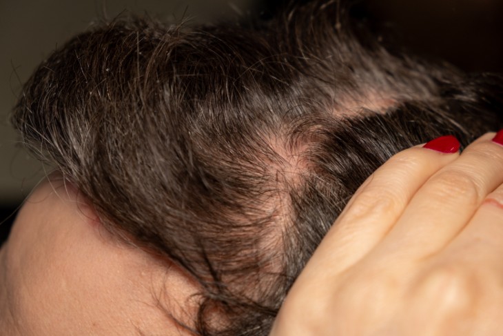 scalp skin conditions
