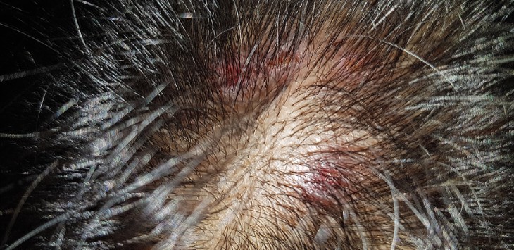scalp skin conditions