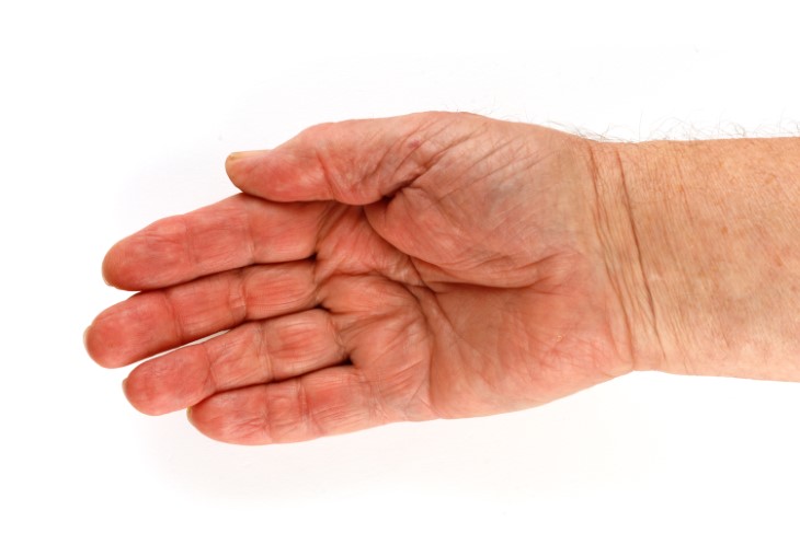 The Four Stages of Rheumatoid Arthritis