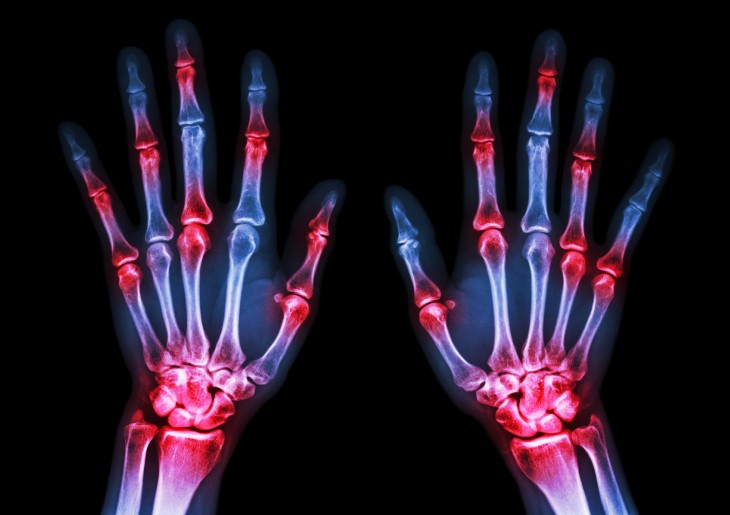 The Four Stages of Rheumatoid Arthritis