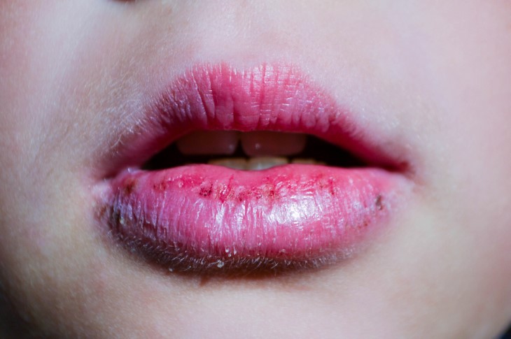 dry lips