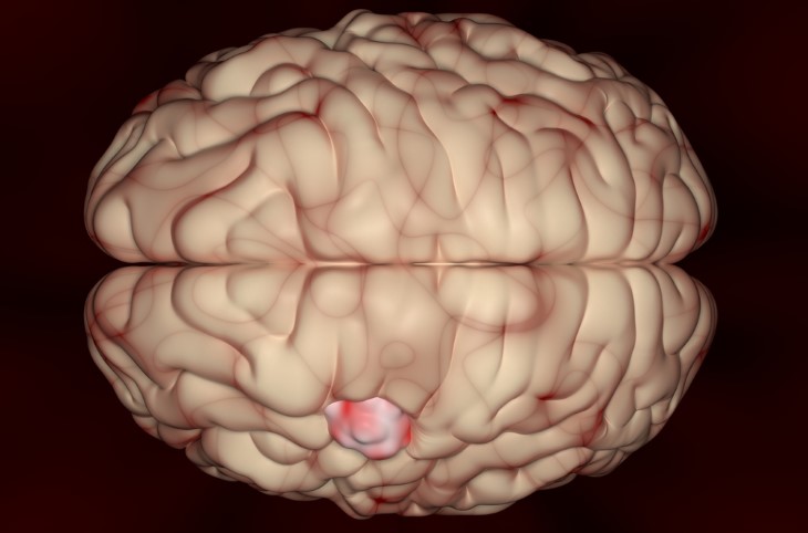 brain cancer