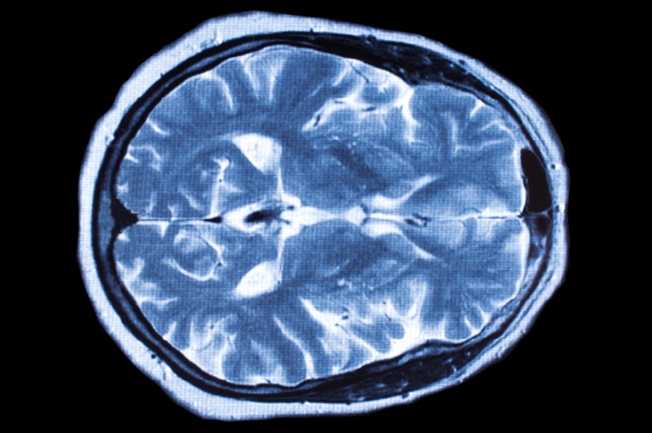 brain cancer